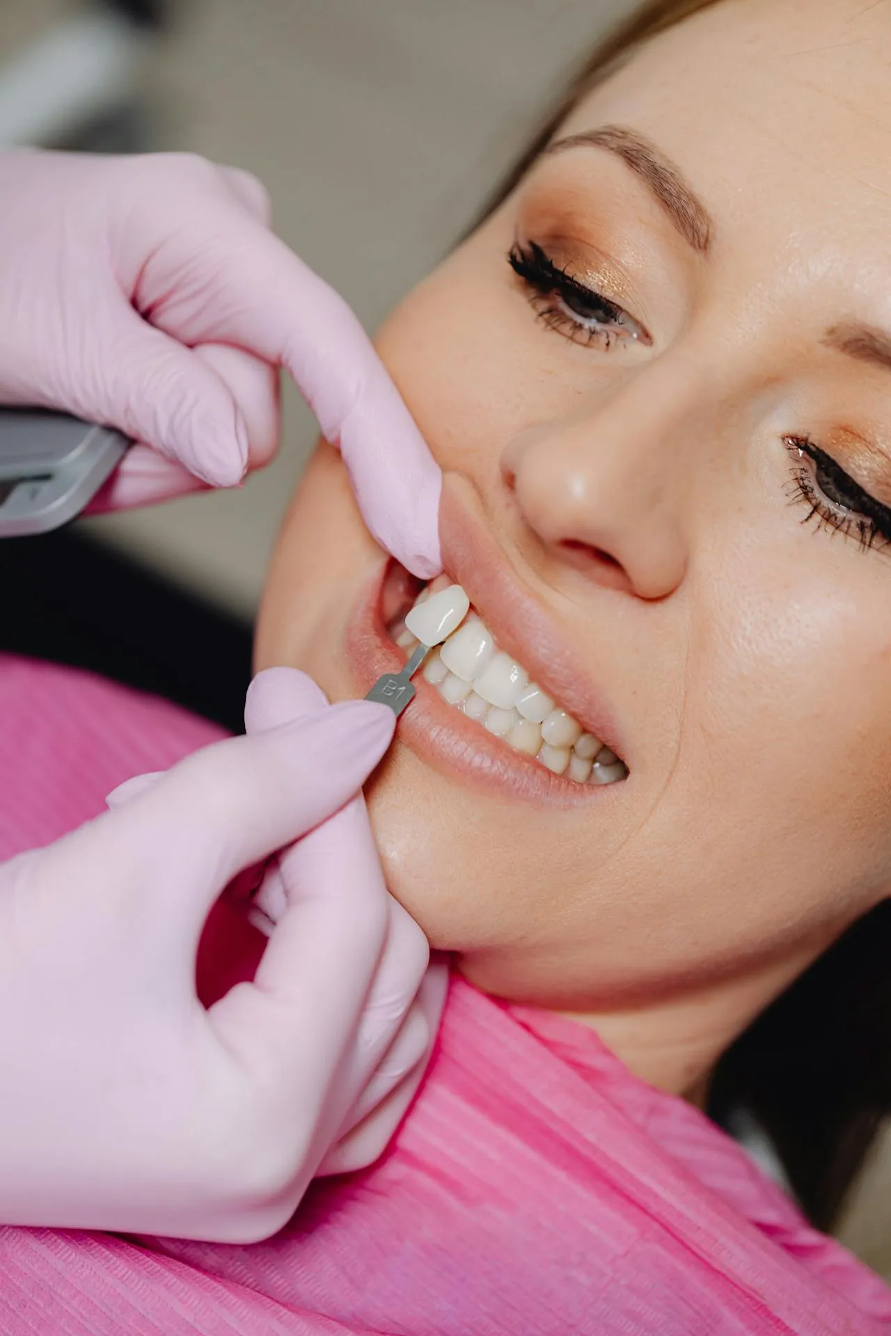 Cosmetic dentist applying a veneer during a Hollywood Smile makeover procedure — precision smile design at a specialist cosmetic dentistry clinic in Turkey
